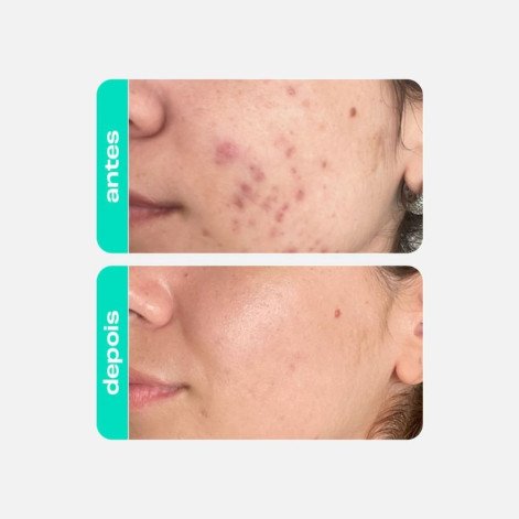 Creamy Skincare Creme Facial Glicointense Peel 30g