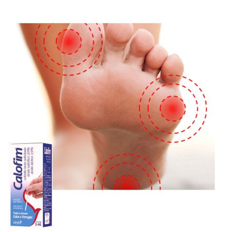 Calofim Para Calos E Verrugas 5ml Adulto E Pediatrico